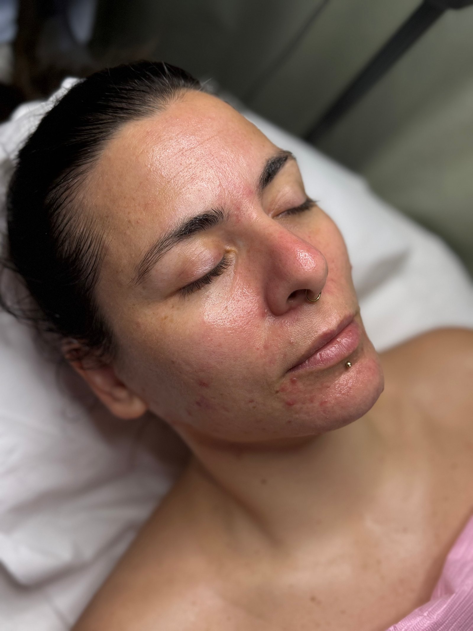 After skin booster