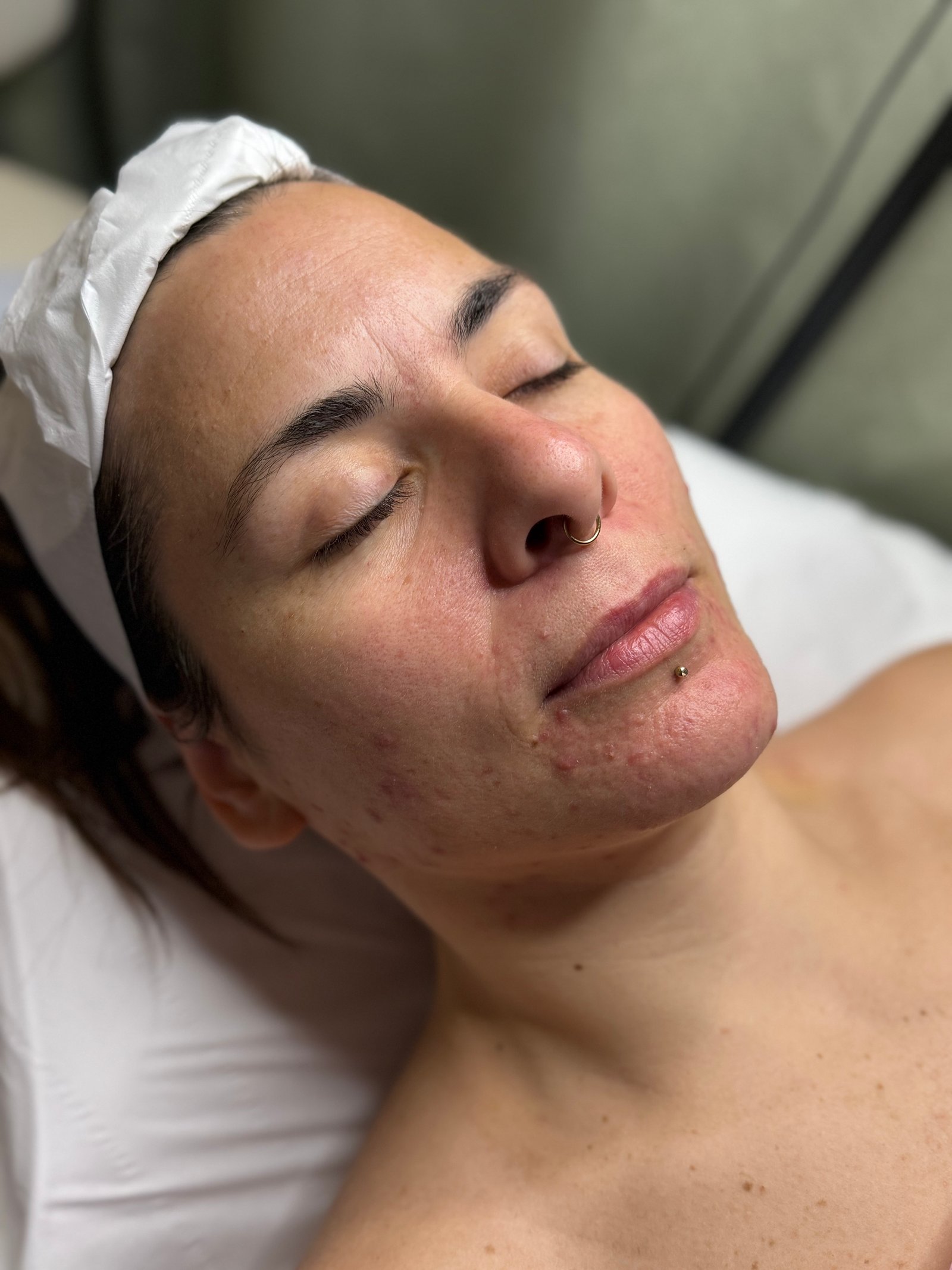 Before skin booster